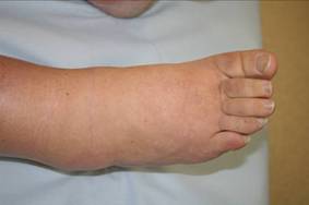 Figure 5b – Mild primary lymphoedema of the foot/lower leg